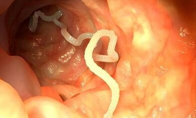 Uzroci parazita u ljudskom tijelu