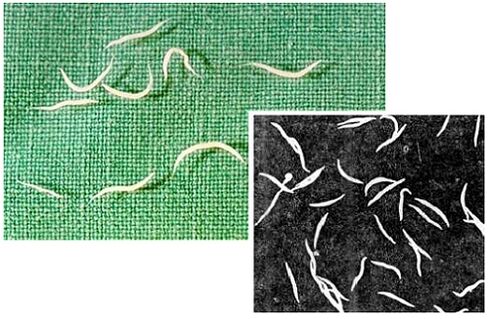 pinworms iz ljudskog tijela